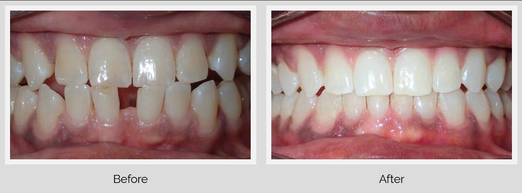 Comparison of dental results before and after treatment.