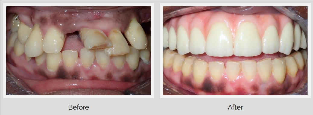 Before and after dental treatment showing improved teeth alignment and whitening.