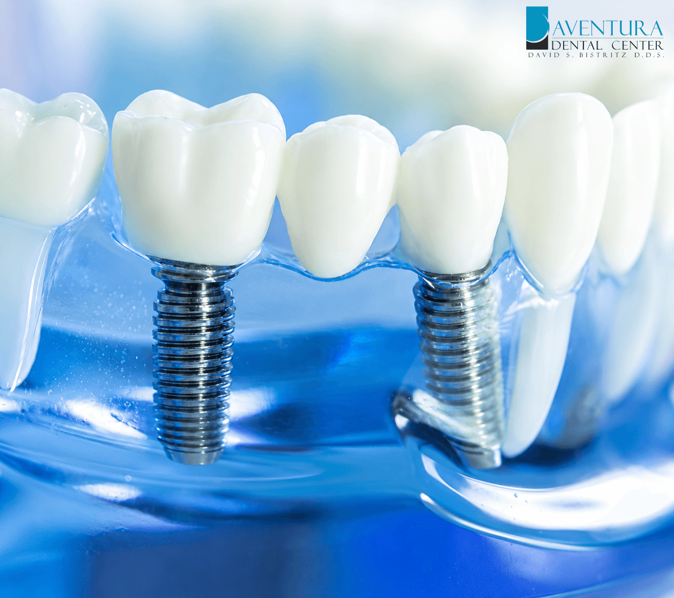Your Go-To Guide for Dental Implants: Smile Brighter in Aventura, FL