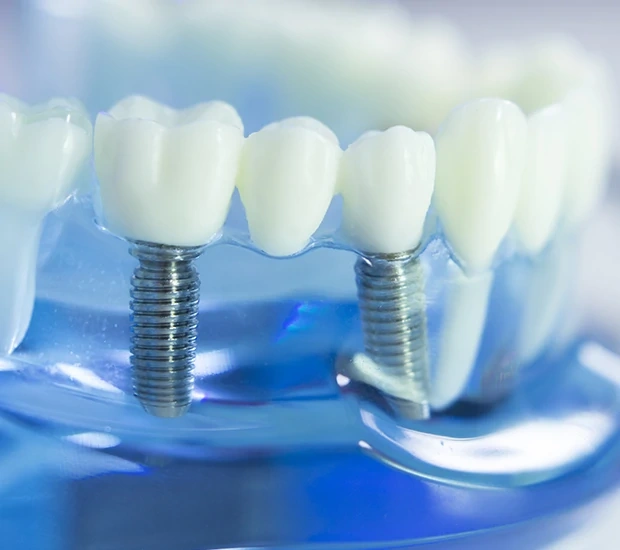 Close-up of dental implants in a model jaw.
