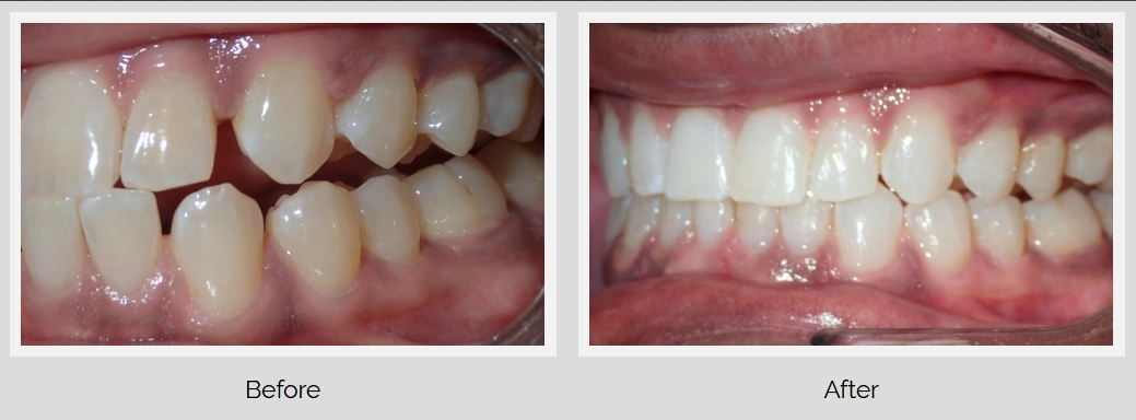 Teeth before and after dental treatment comparison