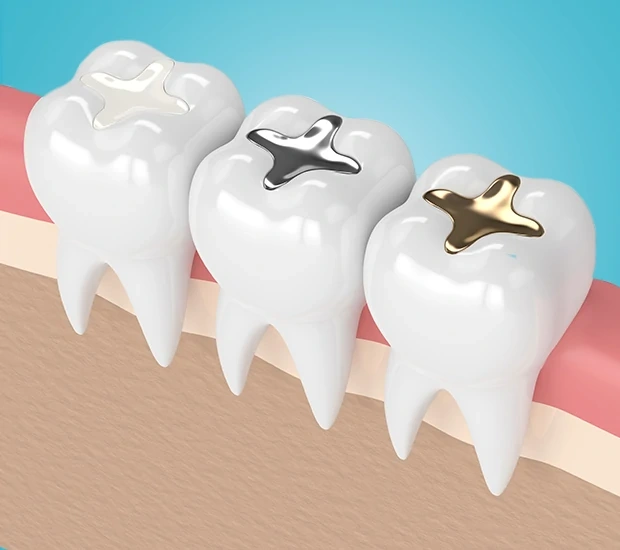 Modern Dental Fillings: Healthier Teeth and a More Natural Smile