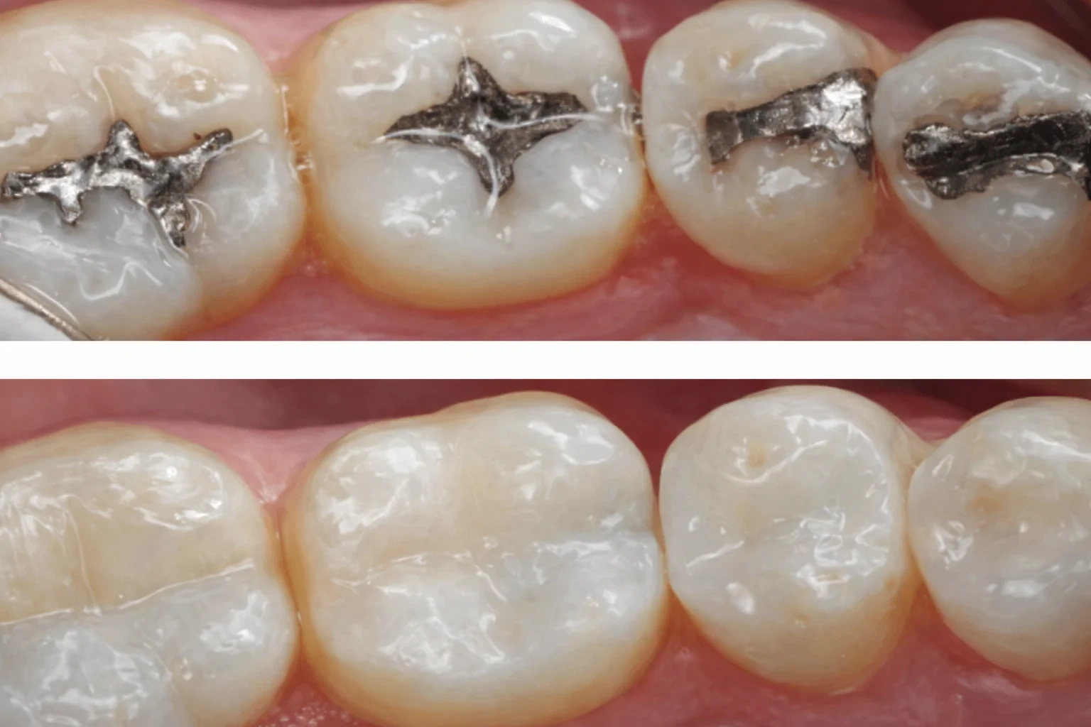 Before and after dental treatment showing teeth restoration