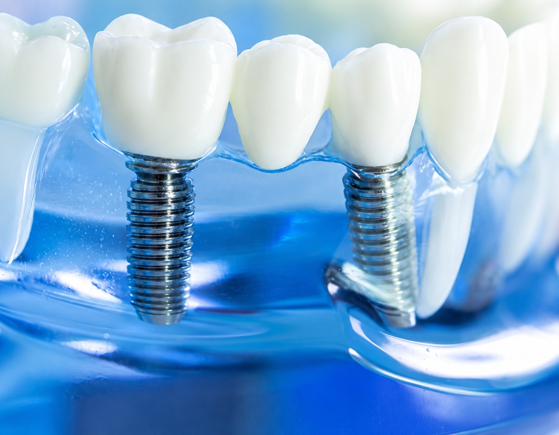Your Go-To Guide for Dental Implants