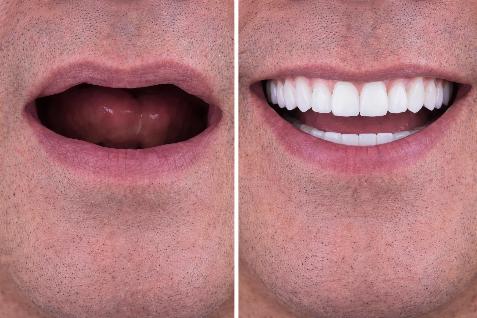 Full Mouth Reconstruction