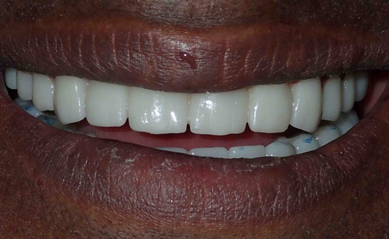 Full Arch Implant Dentures