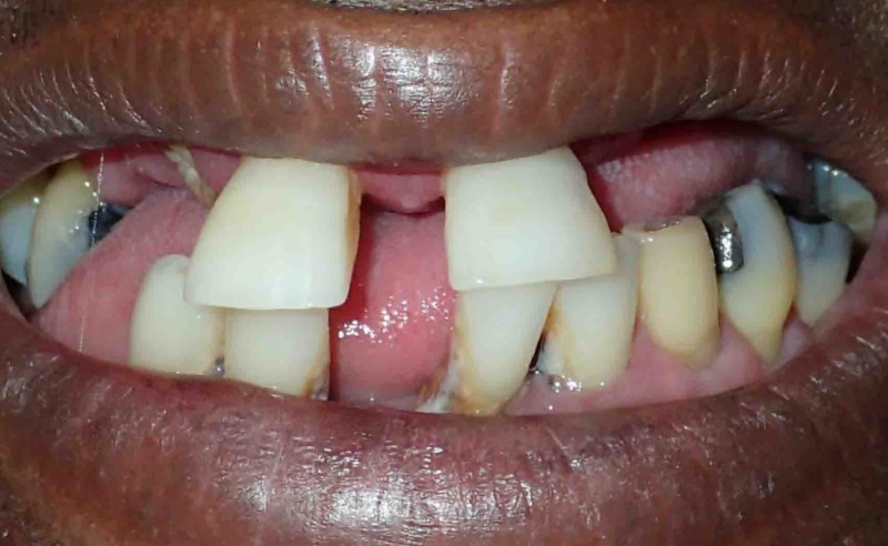 Full Arch Implant Dentures