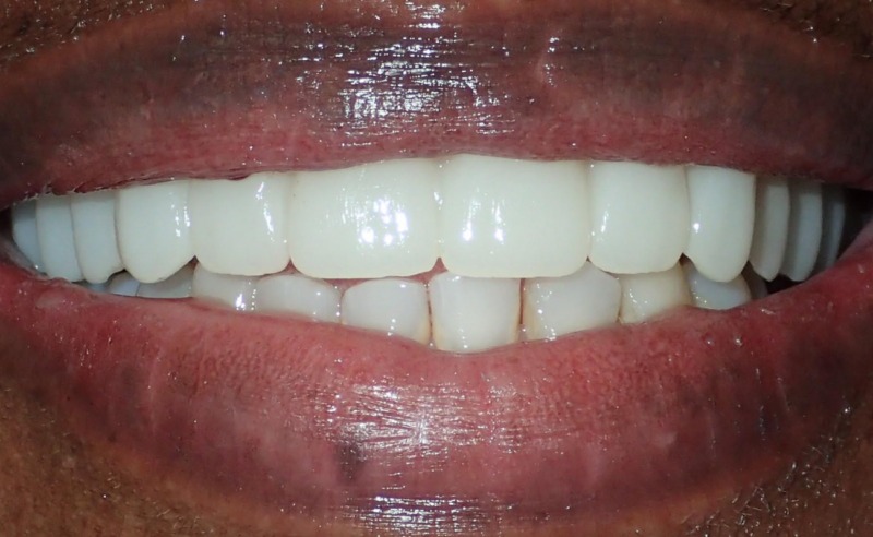 Full Arch Implant Dentures