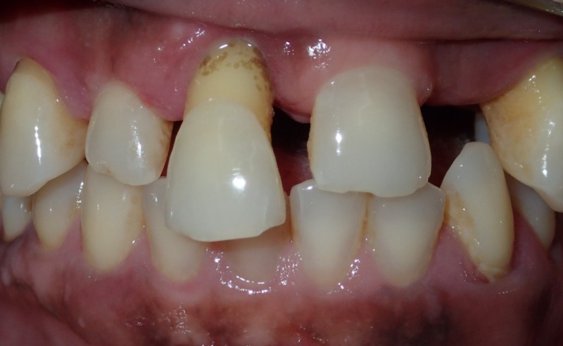 Full Arch Implant Dentures