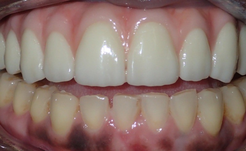 Full Arch Implant Dentures