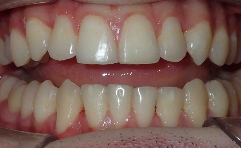 Full Arch Implant Dentures