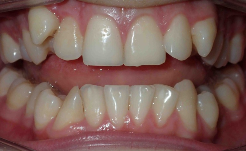 Full Arch Implant Dentures