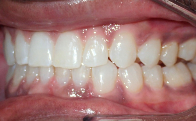 Full Arch Implant Dentures