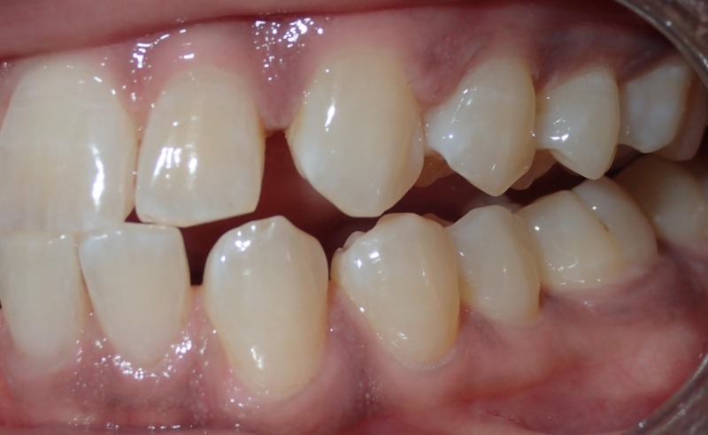 Full Arch Implant Dentures