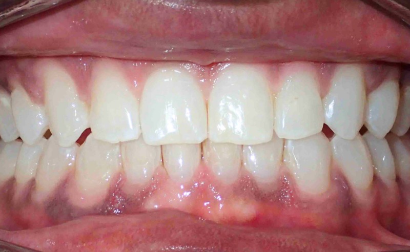 Full Arch Implant Dentures