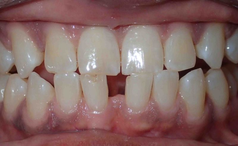 Full Arch Implant Dentures