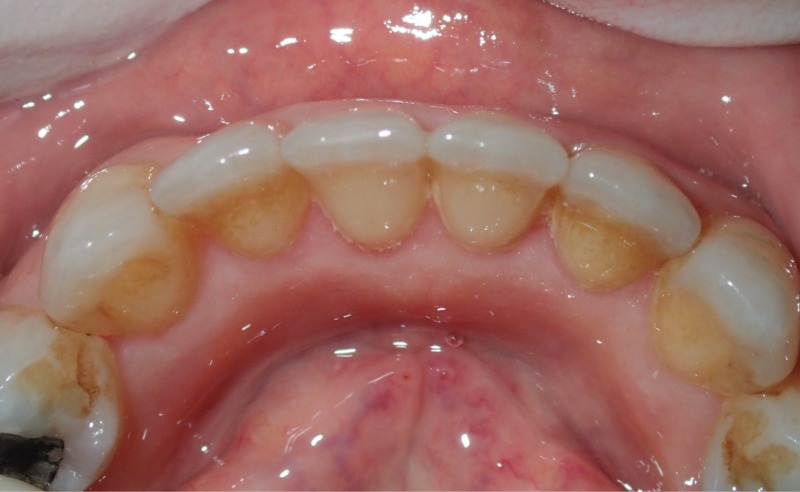 Full Arch Implant Dentures