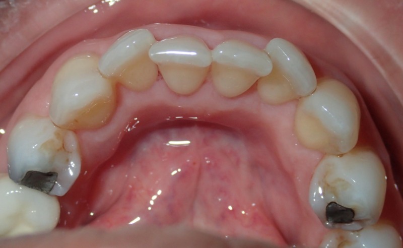 Full Arch Implant Dentures