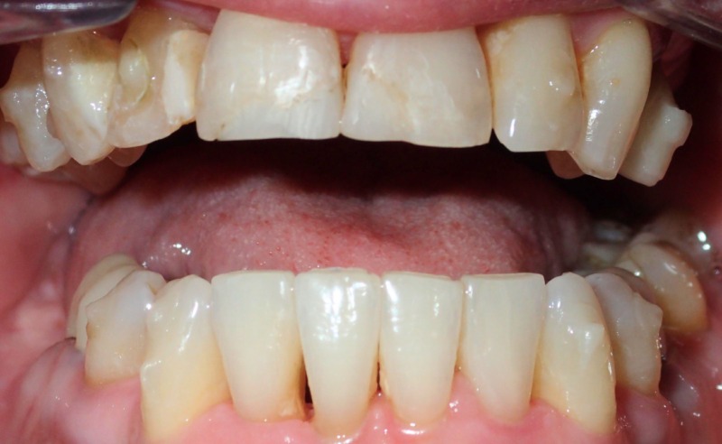 Full Arch Implant Dentures