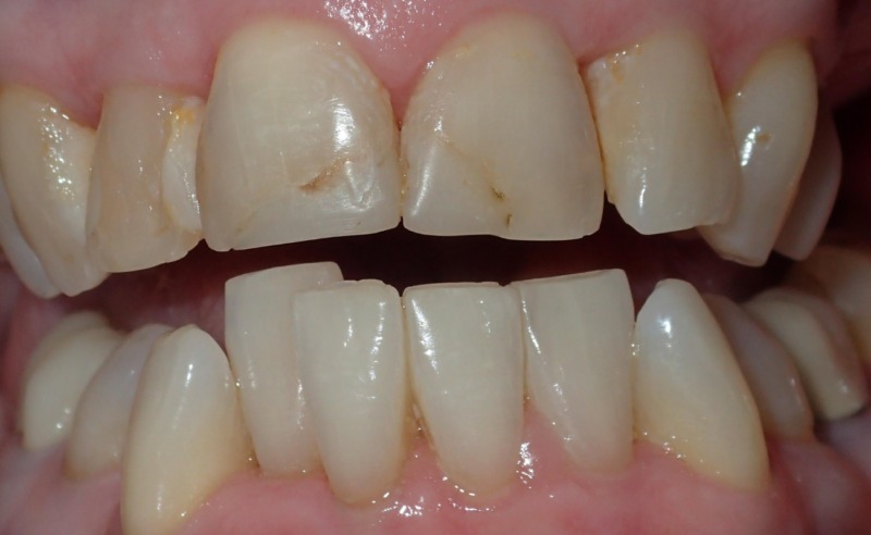 Full Arch Implant Dentures