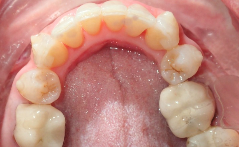 Full Arch Implant Dentures