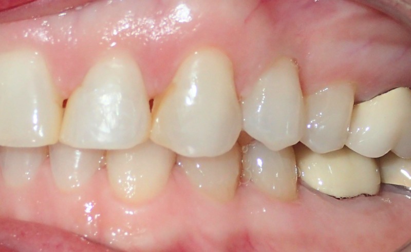 Full Arch Implant Dentures