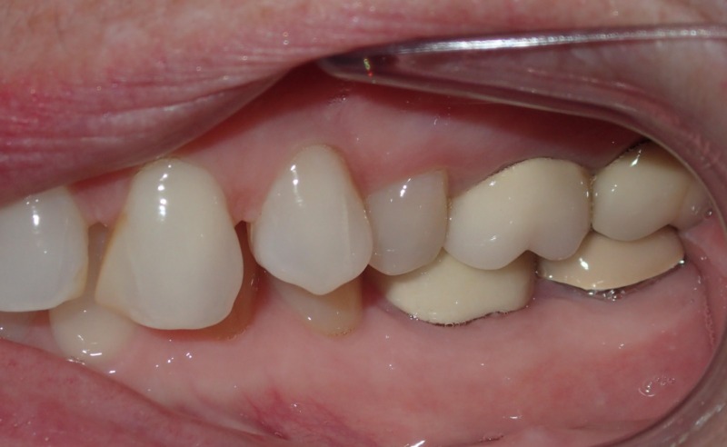 Full Arch Implant Dentures