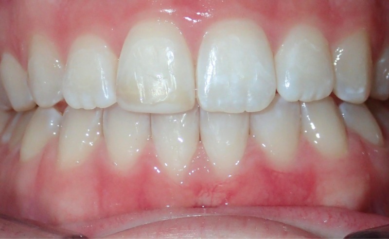 Full Arch Implant Dentures