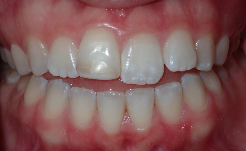 Full Arch Implant Dentures