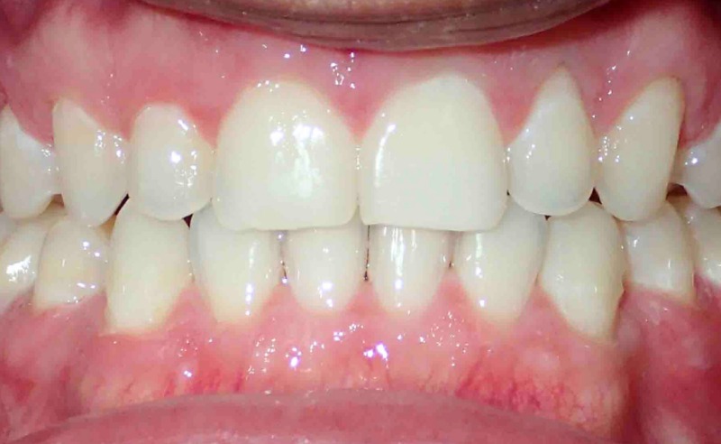 Full Arch Implant Dentures