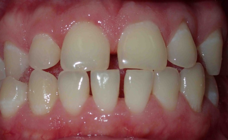 Full Arch Implant Dentures