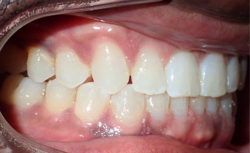 Full Arch Implant Dentures