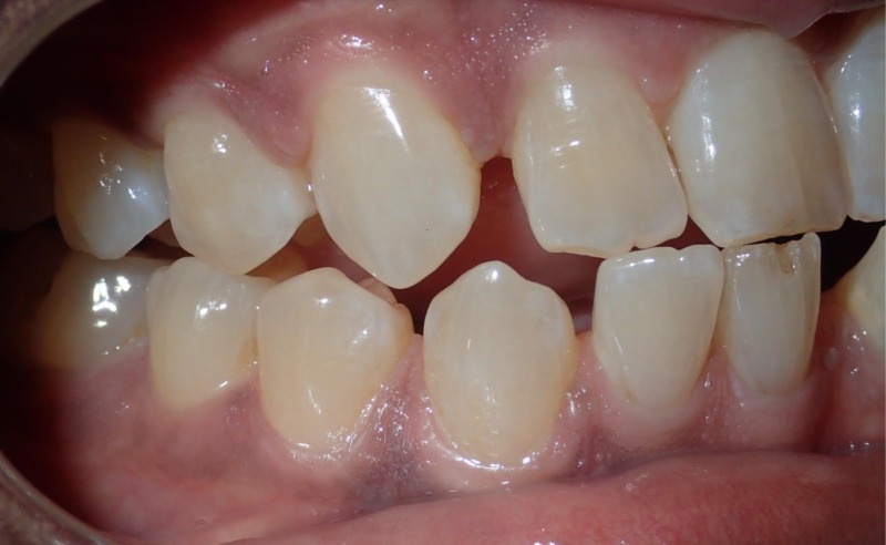 Full Arch Implant Dentures