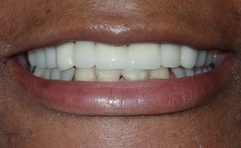 Full Arch Implant Dentures