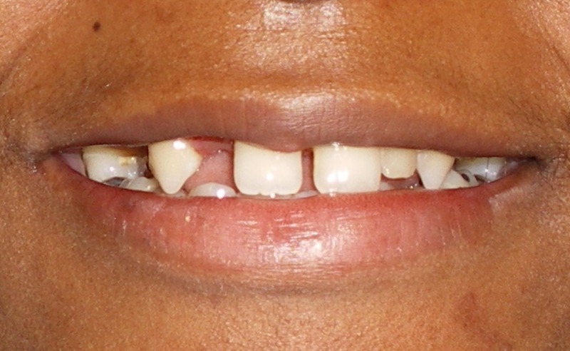 Full Arch Implant Dentures