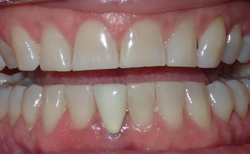 Full Arch Implant Dentures