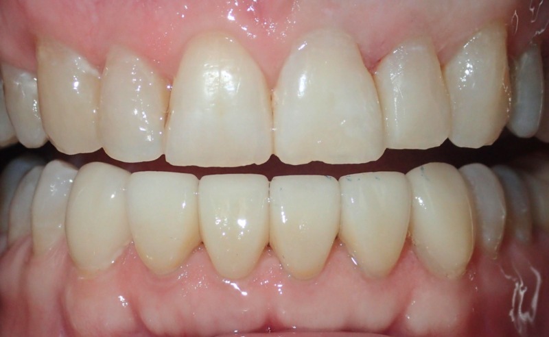 Full Arch Implant Dentures