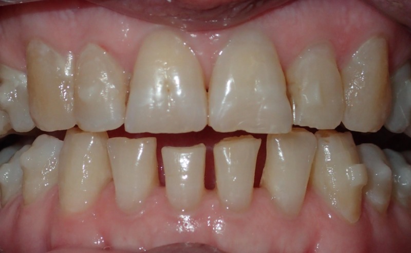 Full Arch Implant Dentures