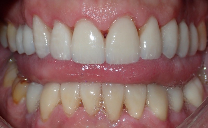 Full Arch Implant Dentures