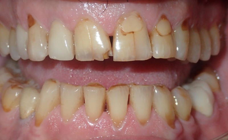 Full Arch Implant Dentures