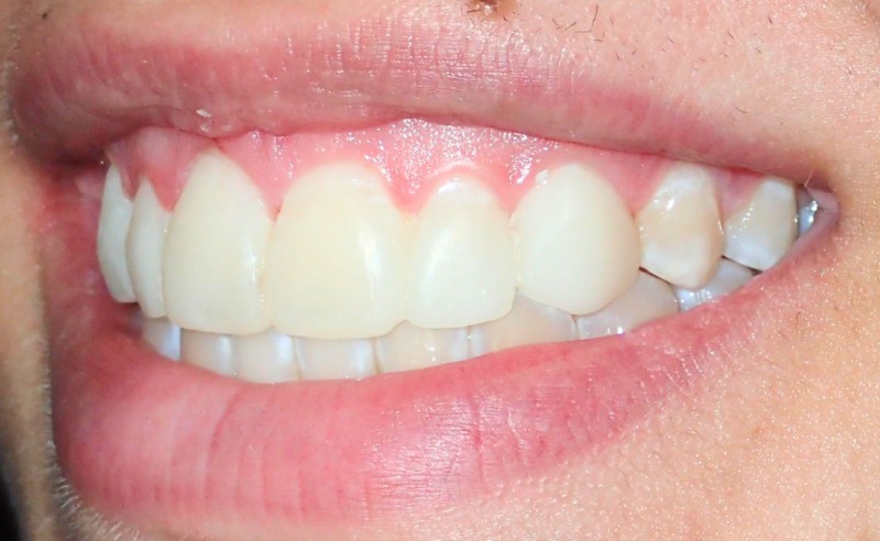 Full Arch Implant Dentures