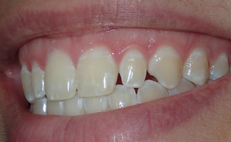 Full Arch Implant Dentures