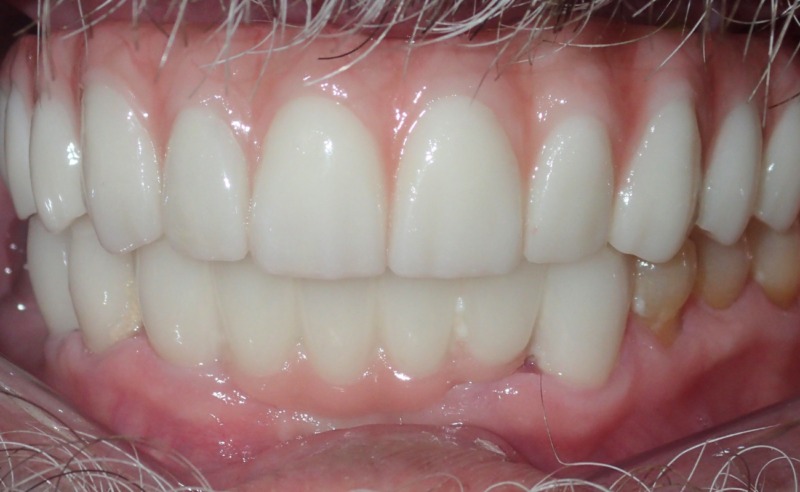 Full Arch Implant Dentures