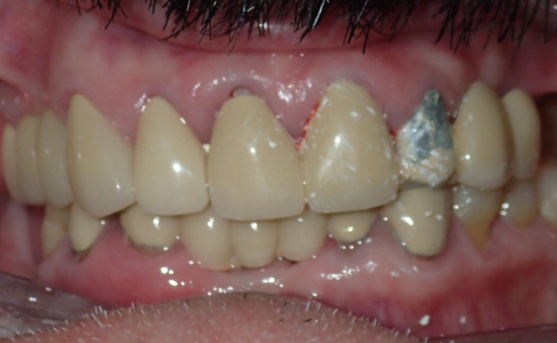 Full Arch Implant Dentures