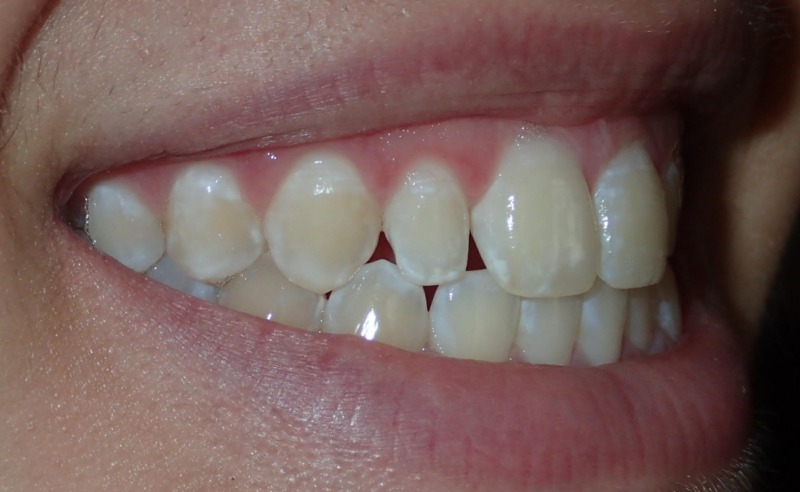 Full Arch Implant Dentures