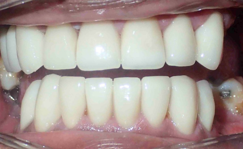 Full Arch Implant Dentures