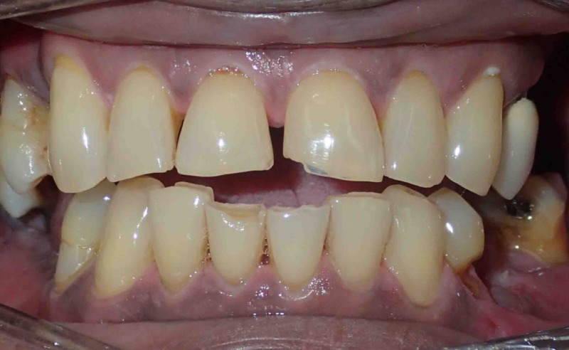 Full Arch Implant Dentures