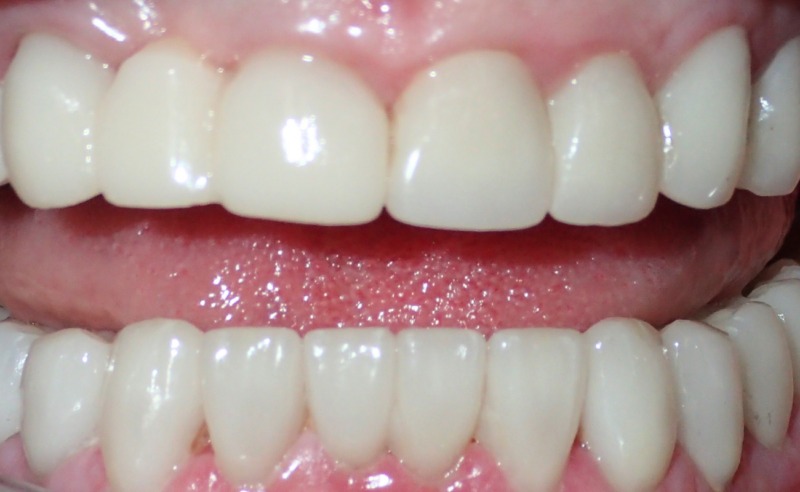 Full Arch Implant Dentures