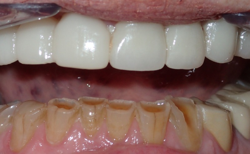 Full Arch Implant Dentures