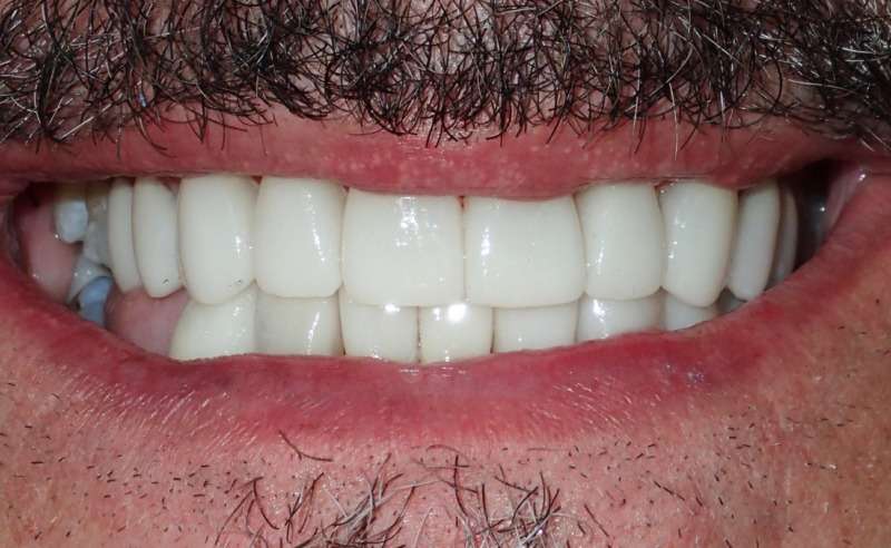 Full Arch Implant Dentures